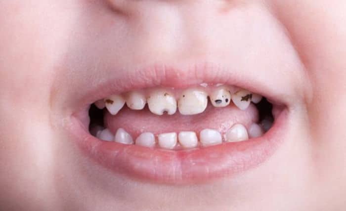 Bebeklerde Diş Çıkarma Dönemi: Belirtiler, Tedbirler ve Beslenme Önerileri