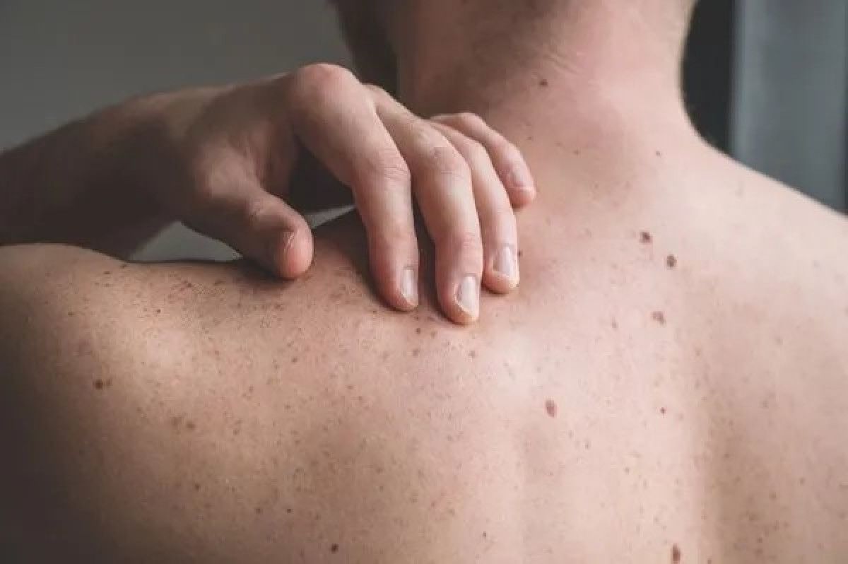 Timeless Remedies for Skin Blemishes