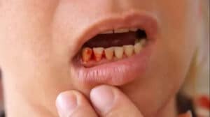 Diş kanaması orucu bozar mı? Ramazan ayında ağız sağlığı ve