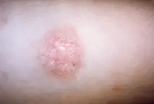 Vücutta Oval Pembe Lekeler Neden Olur? Pityriazis Rozea Belirtileri
