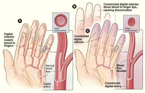 Raynaud fenomeninde parmaklarda soğuğa bağlı renk değişikliği