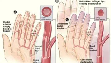 Raynaud fenomeninde parmaklarda soğuğa bağlı renk değişikliği