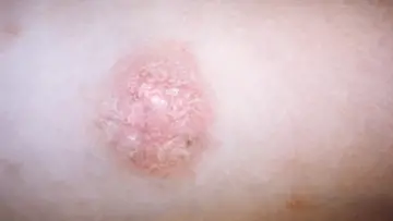 Pityriazis rozea cilt döküntüsünde oval biçimli öncü plak görüntüsü
