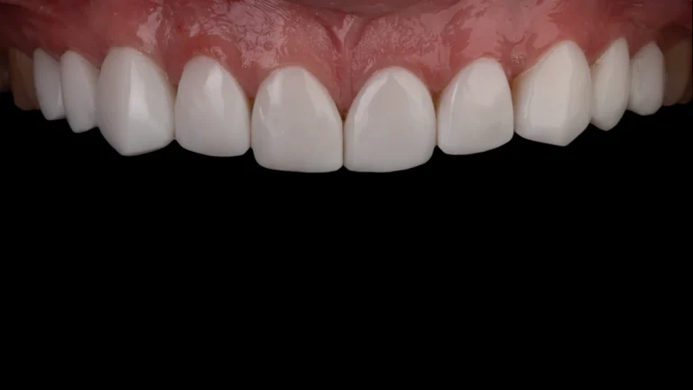 Diş kaybını gösteren gerçek dental fotoğraf; rüyada diş dökülmesi temasını anlatan görsel