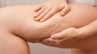Lipödem: Selülit Gibi Görünen Farklı Bir Durum